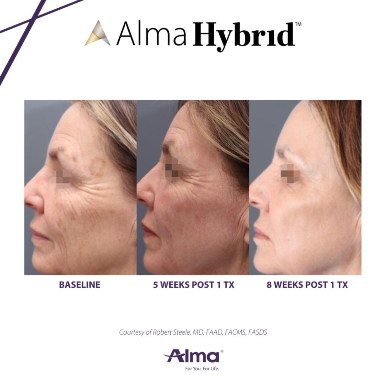 Alma hybrid results photo.